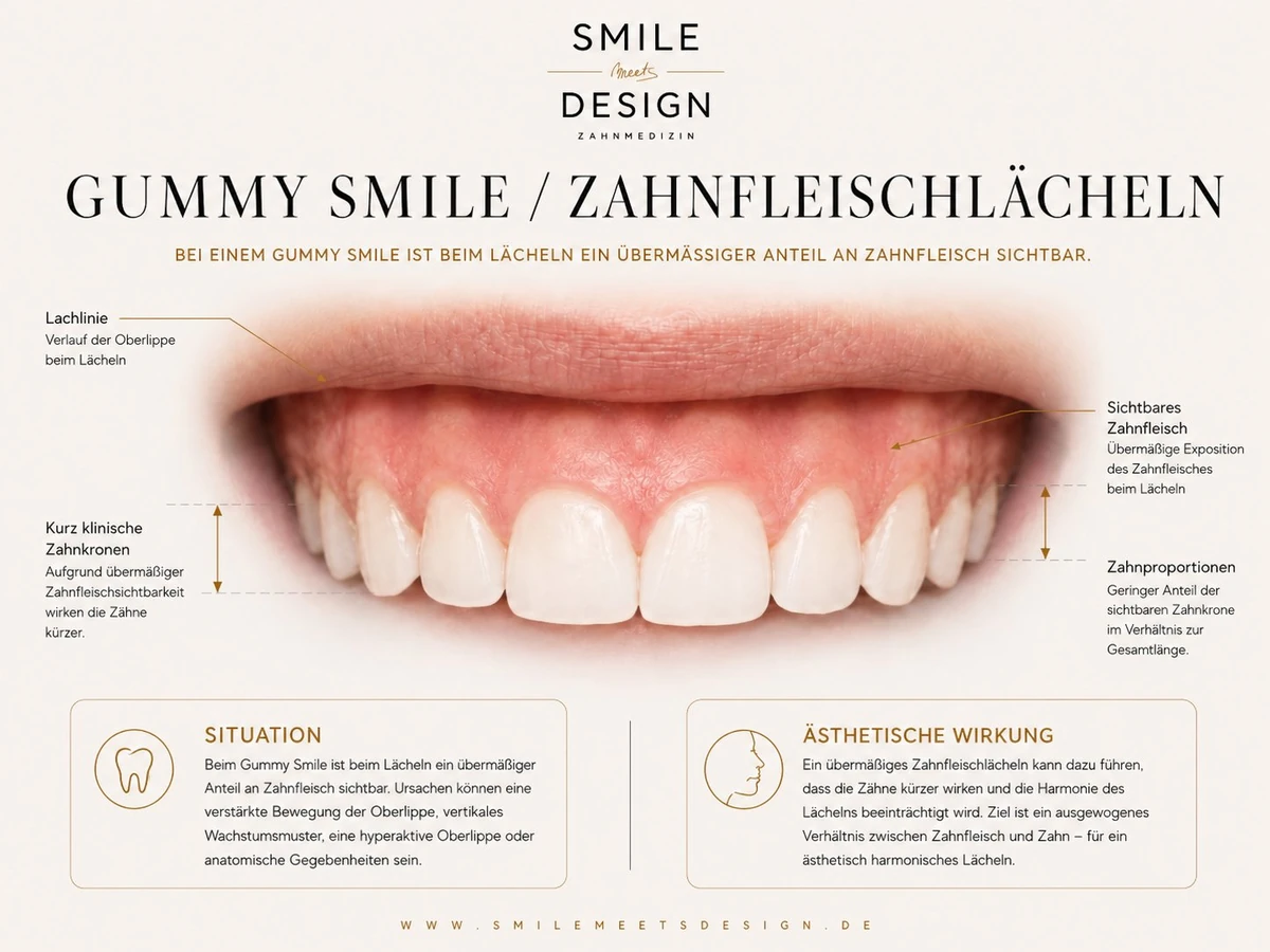 Rot-Weiß-Ästhetik: Korrektur des Gummy Smile durch chirurgische Kronenverlängerung. Die aktuelle Zahnfleischlinie wird auf den geplanten, idealen Zahnfleischverlauf nach oben verlagert, um harmonische Zahnkronen-Proportionen wiederherzustellen.
