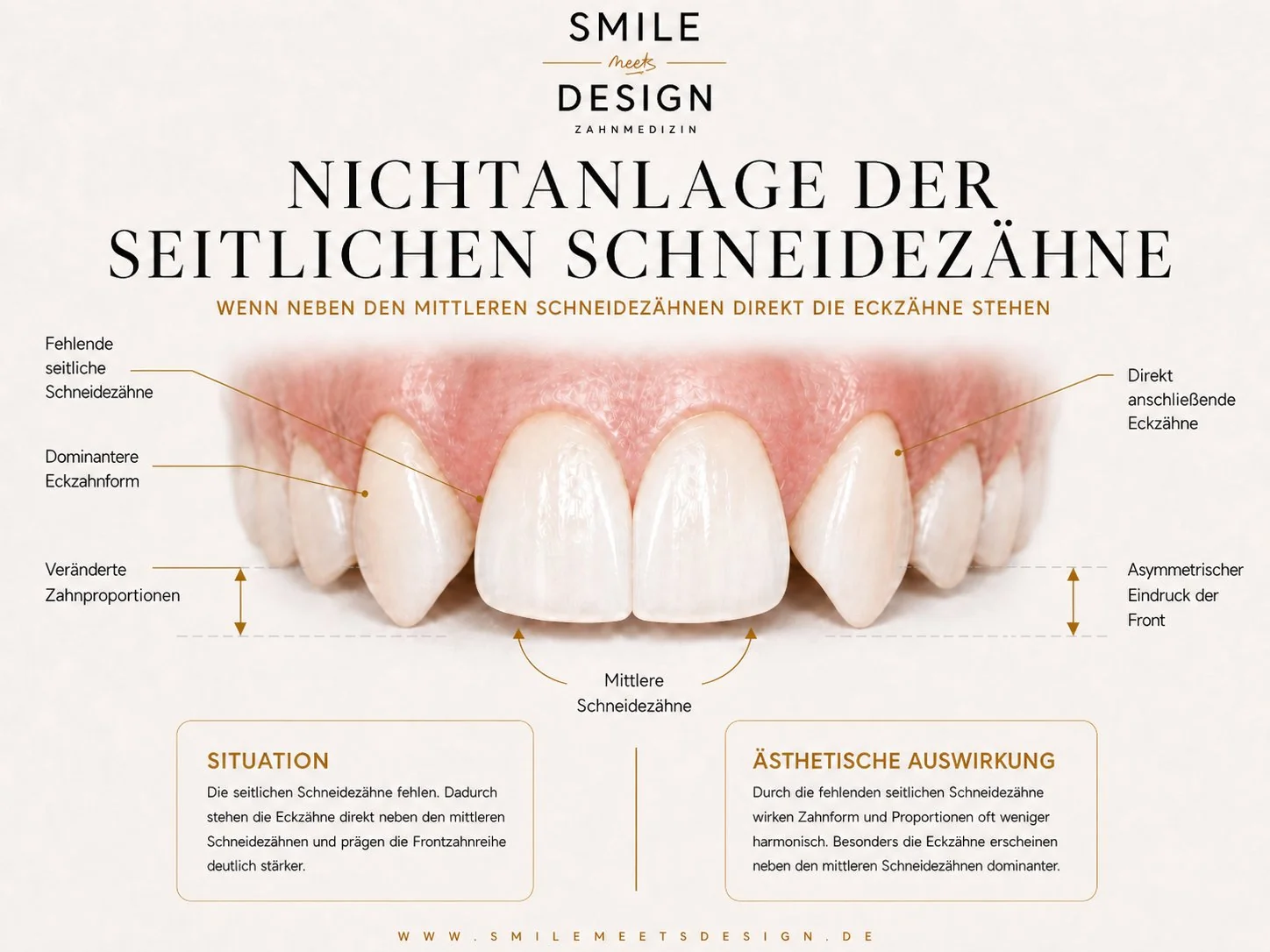 Nichtanlage der seitlichen Schneidezähne: Bei etwa 2 % der Bevölkerung fehlen die seitlichen Schneidezähne. Die Eckzähne rücken direkt an die mittleren Schneidezähne und prägen die Frontzahnreihe stärker. Veneers können die Eckzähne in die Form seitlicher Schneidezähne umarbeiten und harmonische Proportionen wiederherstellen.