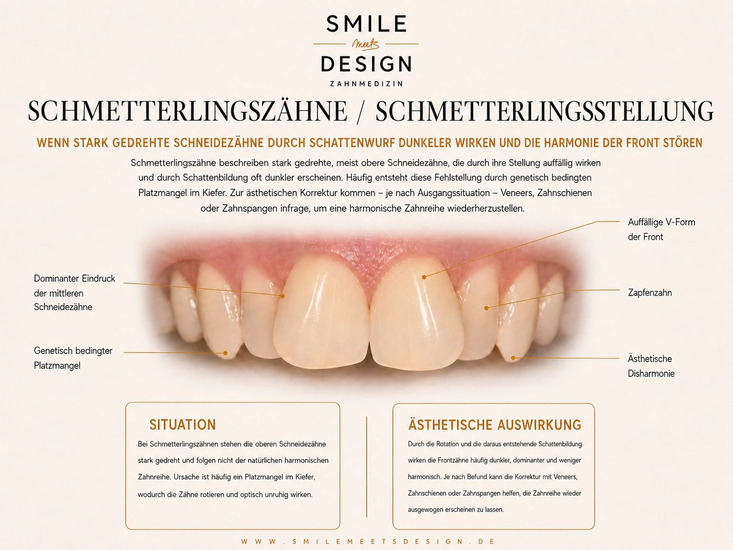 Schmetterlingszähne / Schmetterlingsstellung: Stark gedrehte obere Schneidezähne, die durch ihre Rotation eine V-Form der Front bilden und durch Schattenbildung dunkler wirken. Häufig entsteht diese Fehlstellung durch genetisch bedingten Platzmangel im Kiefer.